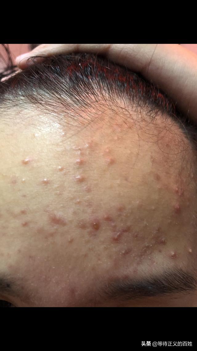 头条问答 - 女儿十二岁,脸上长满了红痘痘,有什么好办法?请条友们支招