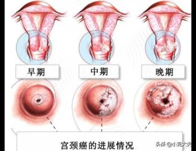 宫颈癌发出的第一个信号:宫颈癌早期的3个信号是什么？