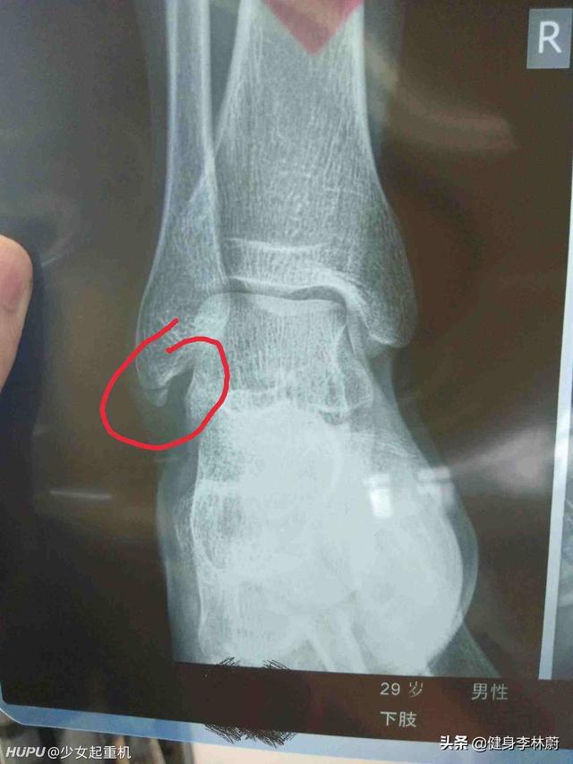 头条问答 - 脚崴3个月内踝不消肿怎么办,拍片有撕脱性小骨粒,当时没有