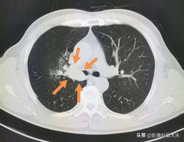 不影响寿命的十大癌症:哪些癌症是已发现且好治疗的？ 不影响寿命的十大癌症 肾癌