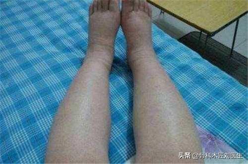 甲状腺机能减退是甲亢还是甲减:甲状腺功能减退有何症状？