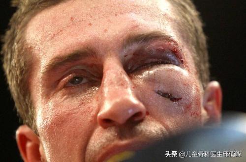 有骨折或者骨折轻微没有移位,会慢慢消退,个别因为皮下血肿包裹起来了