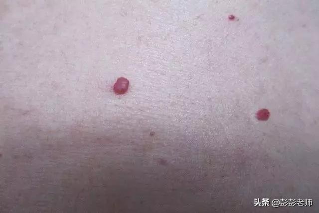 红痣究竟是不是变老、肝病的前兆？