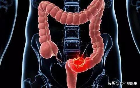 小腸癌癥狀不明原因腹脹疼痛與貧血 竟是罕見小腸癌作祟 Bdrbmi