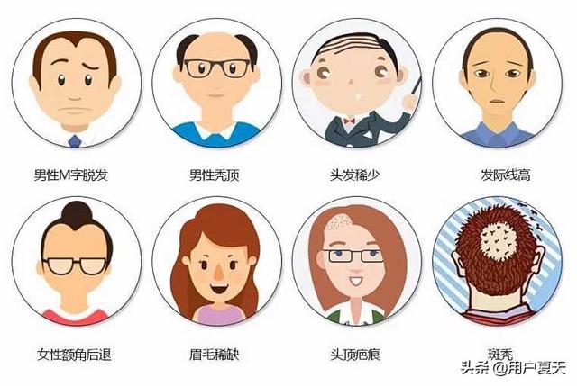 年轻人脱发原因(年轻人脱发原因脂溢性脱发怎么办)