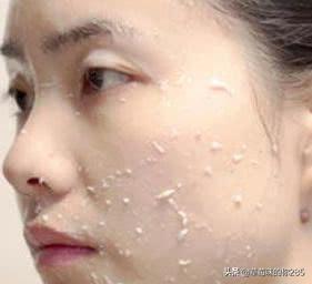 毛孔芝麻:毛孔近看一个个像小洞，还往外流油，这到底是怎么回事？