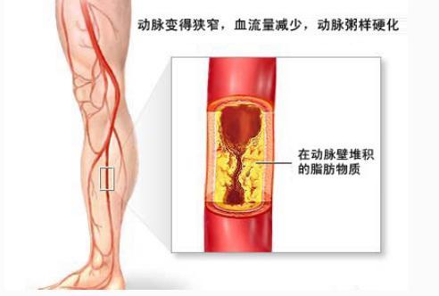 人体血管堵,人体血管堵塞如何清理