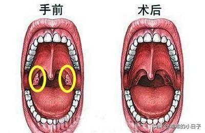 2,其次,可以用物理止痛的方法,可以找护士要个冰袋冷敷在下颚处与