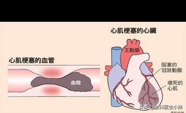 心脏支架后为什么有些人虚弱不堪,但有些人和正常人一样呢？