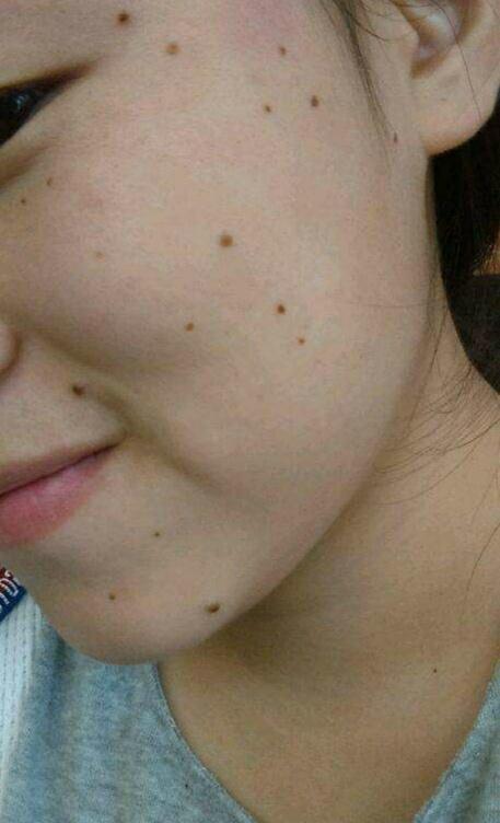 如果是黑头粉刺,以及日晒和生活作息不规律引起的黑点,平时注意皮肤