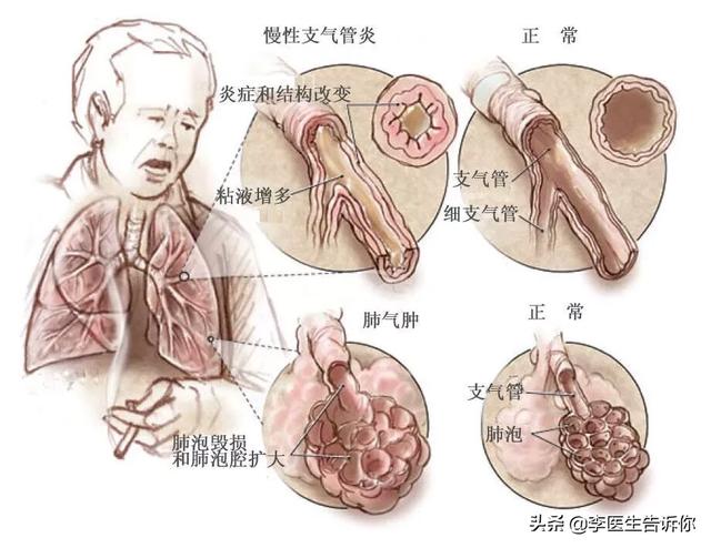 头条问答 - 如何区别慢阻肺,肺气肿,支气管哮喘和慢性支气管炎?