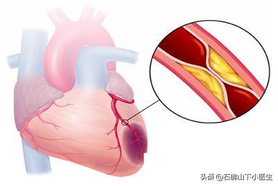 冠心脏病的症状有哪些:冠心病和其他心脏病的症状有什么不同？