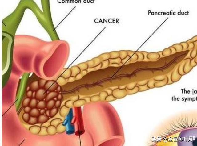乔布斯胰腺癌:胰腺癌一般哪里会出现疼痛