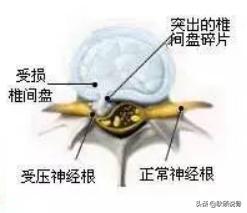 颈神经根炎的症状与治疗:颈椎椎间盘突出C3C4C5压迫神经根及硬膜囊是什么症状？