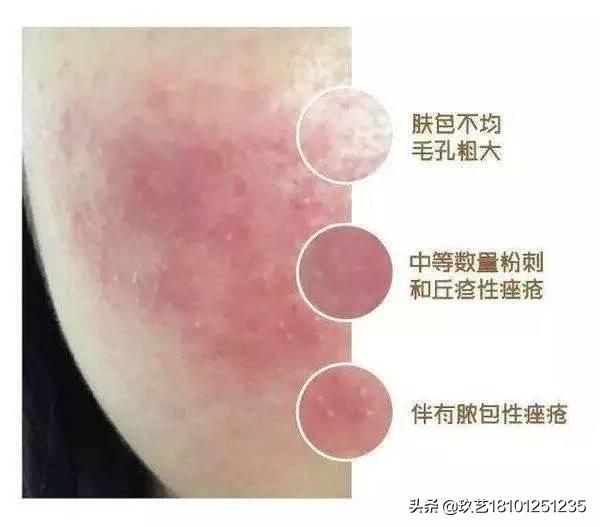 皮肤发红怎么办:脸部皮肤发红发痒怎么办 秋冬皮肤泛红过敏要怎么办？