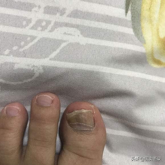 灰指甲刚开始的图片,身体缺什么营养会得“灰指甲”？