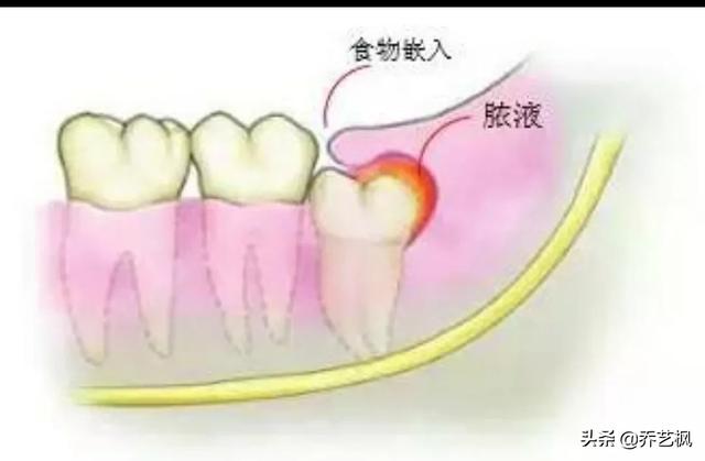 长智齿一定要拔吗,横生的智齿一定要拔掉吗？