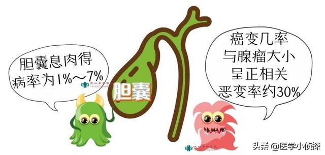 三大抗癌石,胆囊息肉、胆结石会转化为胆囊癌吗？