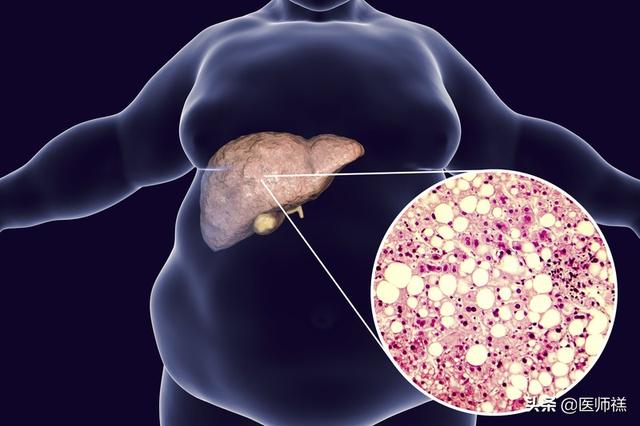 脂肪肝诊疗手册,脂肪肝在超声中怎么看