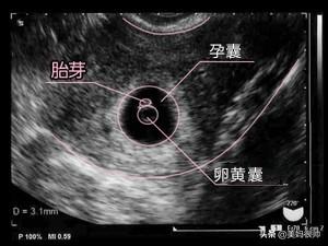 头条问答 怀孕四十天孕囊有多大 需注意什么 美妈很帅的回答 0赞