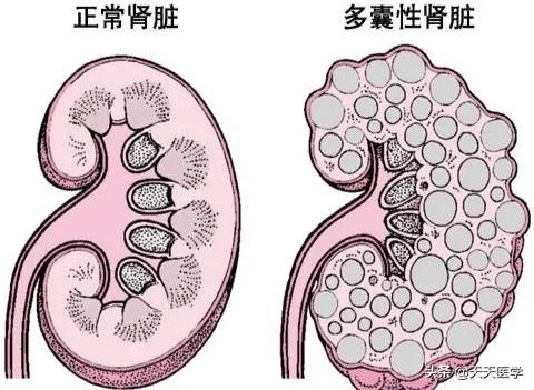 双肾囊肿是怎么引起的，左肾囊肿是什么问题，医院开了消炎药和止痛药，请问这能根治吗