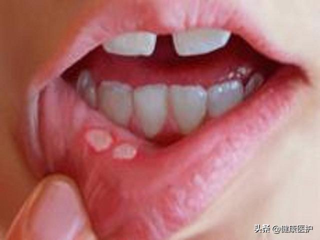 儿童口腔溃疡症状:儿童口腔溃疡是怎么引起的 八岁半儿童，经常口腔溃疡，有什么好的办法？