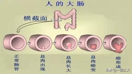 预防肠道疾病教学设计:幼儿园预防肠道疾病教案 引起肠癌的原因有哪些？肠癌能预防吗？