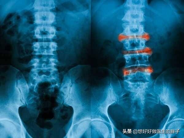 强直性脊柱炎能活多久？