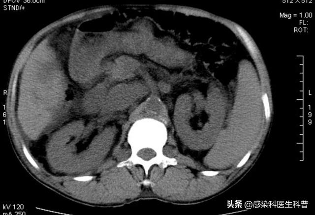 晚期糖尿病有什么症状:晚期糖尿病有什么症状表现 肝硬化严重身体会有什么症状吗？