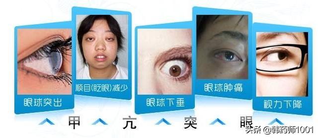 什么是甲减有什么症状,甲亢,甲减,甲状腺结节都分别是什么