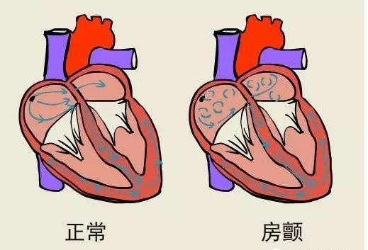心房顫動需要註意什麼？