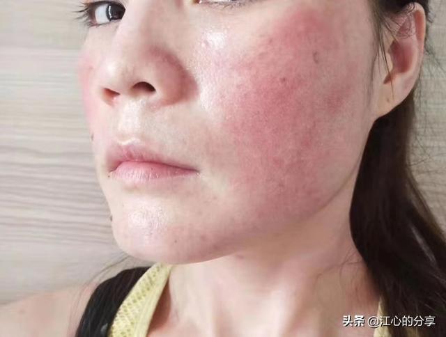 欧莱雅怎么样？能修复红血丝吗？