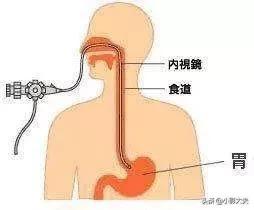 胃镜怎么做的过程:胃镜痛苦吗？做胃镜前要做些什么准备？