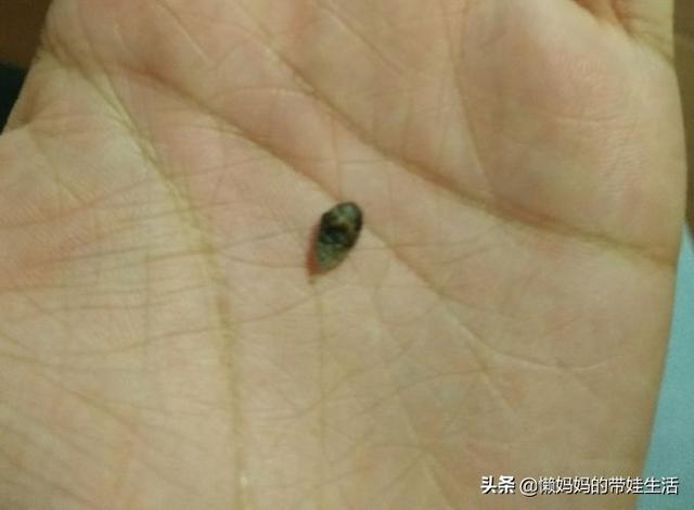 大腿肚内侧黑紫图:怀孕七个月，肚脐里面有黑泥，可以挖出来吗？
