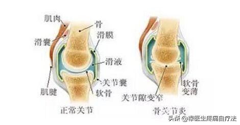 膝盖关节炎症状:膝关节关节炎平时应该注意什么？ 膝盖关节炎症状的早期表现