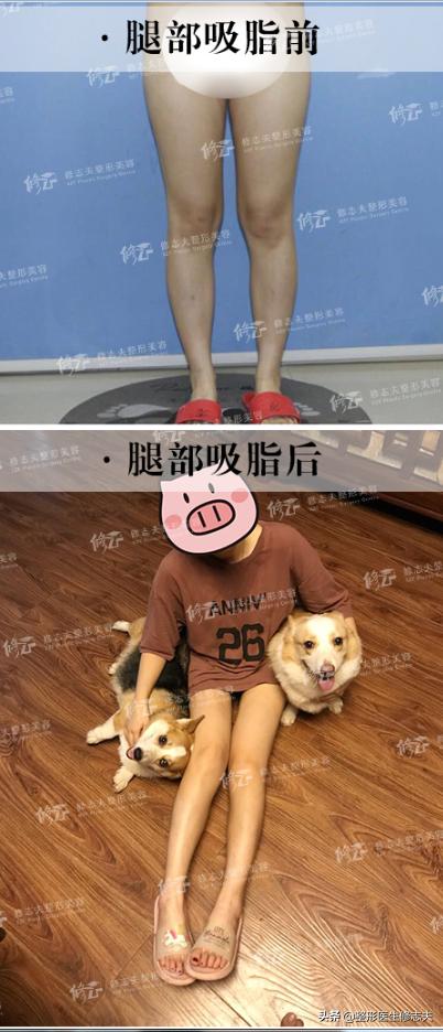 大象腿抽脂大概价格:处于哺乳期的宝妈减肥要采取什么方式减掉大肚子、大象腿(哺乳期减肥不减奶方法)