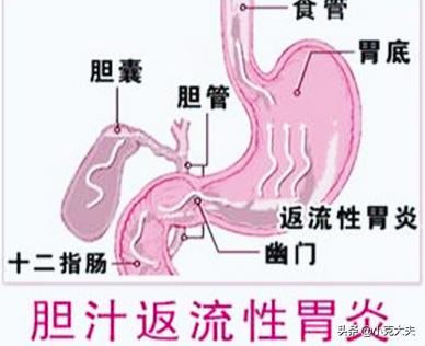 胆汁胃炎的症状及治疗:谁知道治疗胆汁反流性胃炎的药？