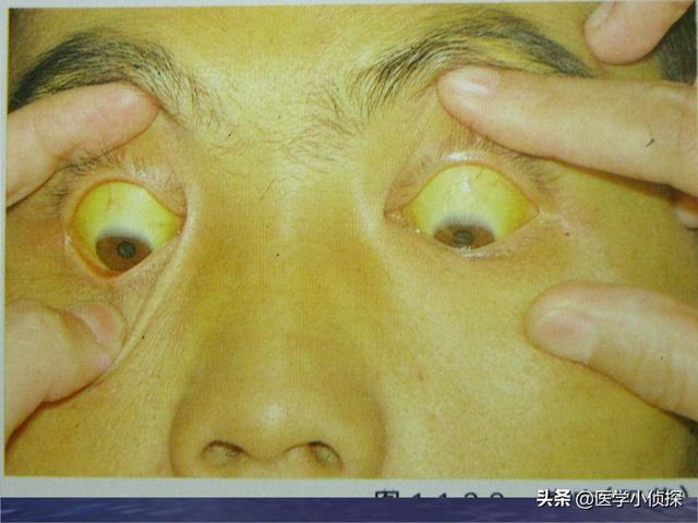 肝痛是在哪个位置图肝癌来临身体会有2处黄3处痛指的是什么