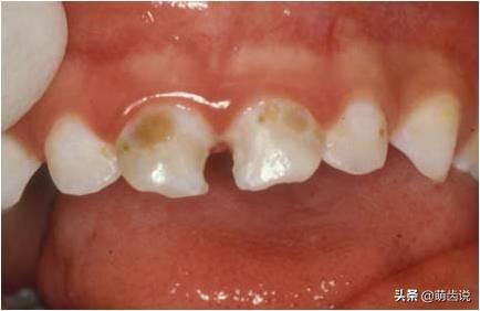 儿童补牙(儿童补牙一般多少钱一颗)