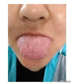 舌头胖大有齿痕，需要怎么调理？插图26