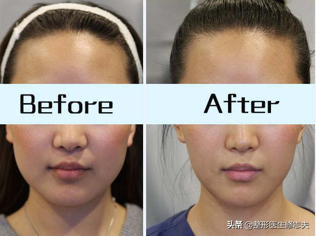 如何瘦咬肌最有效怎样瘦咬肌谁能救救我的大方脸啊