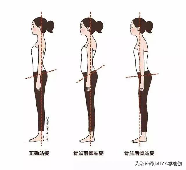 纠正骨盆倾斜最佳方法,盆骨前倾的矫正方法有哪些？