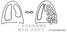 膈疝宝宝的恢复过程:左侧膈疝？膈疝是什么病？