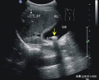 三大抗癌石,胆囊息肉、胆结石会转化为胆囊癌吗？
