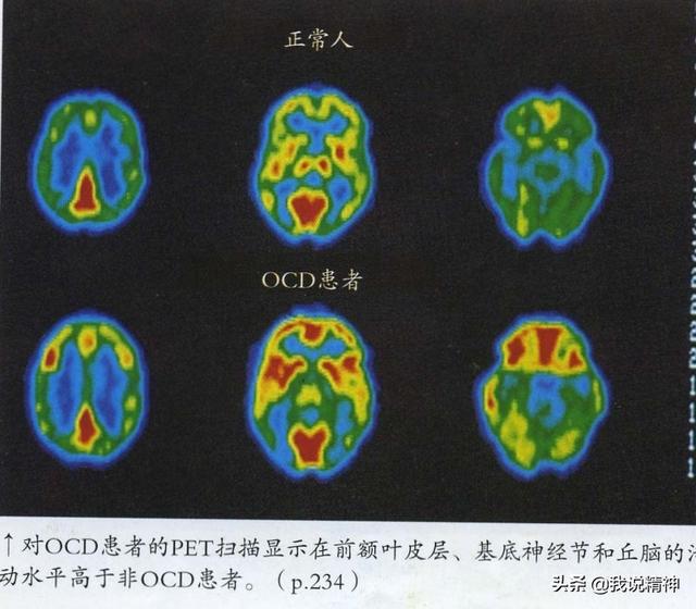 焦虑症引起的肠胃不适的症状:焦虑症引起的肠胃不适怎么治疗 神经症会导致心慌失眠，肠胃紊乱吗？