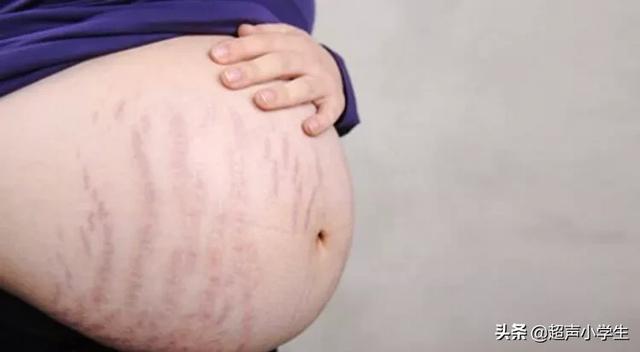 怀孕多久会长妊娠纹？为什么会长妊娠纹？插图10