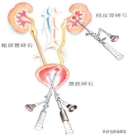 肾不好喝茶还是喝白开水好,肾结石怎么喝水呢，一下喝一杯吗？