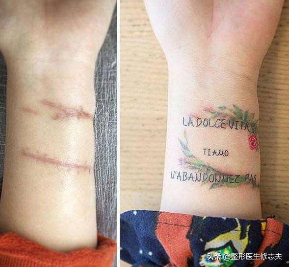 疤痕性体质(疤痕性体质是什么原因导致的)