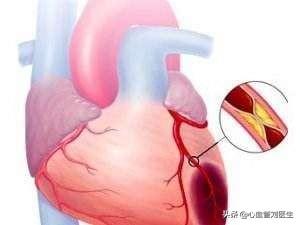 急性心肌梗塞huli:急性心肌梗塞护理诊断与问题 急性心肌梗死患者如何抓住抢救的最佳时机？