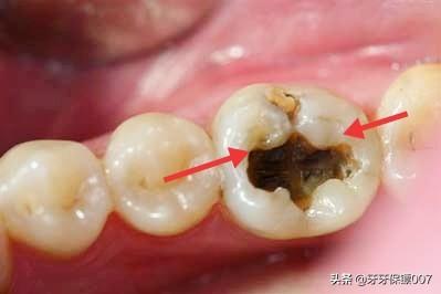 医学知识欠缺时,牙齿表面不知道原因就出现窝洞,只好归咎于被虫子咬的